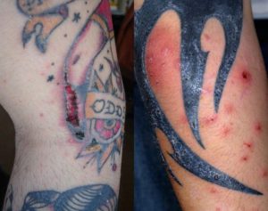 Болезни от татуировок