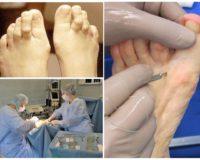 Коррегирующая операция при молоткообразном пальце стопы