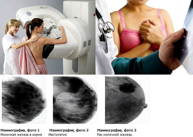 Как Делают Маммографию Молочных Желез Фото