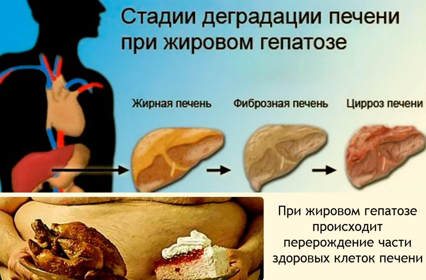 Что такое гепатоз. Гепатоз ожирение печени. Жировой гипотенуз печени. Печень гепатоз жировой гепатоз. Неалкогольная жировая болезнь печени.