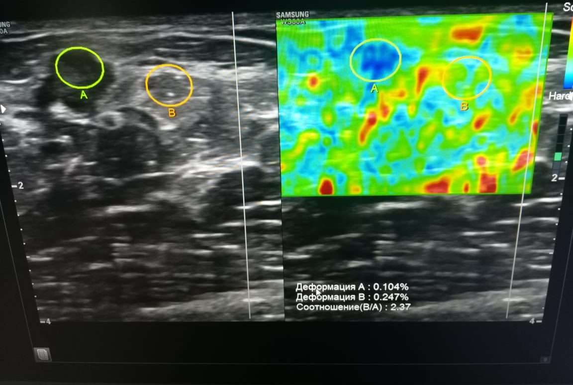 Узи молочной железы когда делать на какой. УЗИ С эластографией молочных желез. Эластография молочной железы. УЗИ молочных желез 9 лет. Аденоз молочной железы на УЗИ.